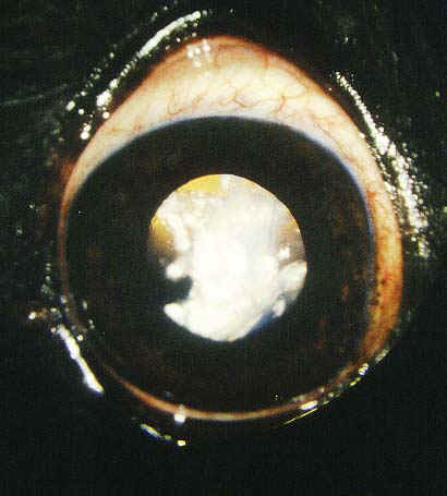 cataract4.jpg (19735 bytes)